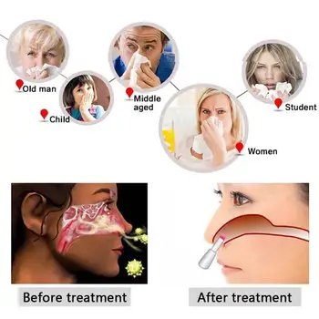 BioNase Zánět Vedlejších Nosních Dutin, Rýma Lék Léčba Nosu Masáž Vyléčit Zařízení Senná Rýma Nízkofrekvenční Pulzní Laser Zdravotní Péče, Terapie